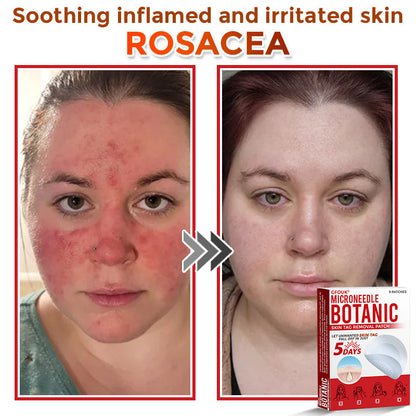 🔥🎇techcrass® MicroNeedle Botanic Skin Tag Removal Patch 🇺🇸 Made in the USA