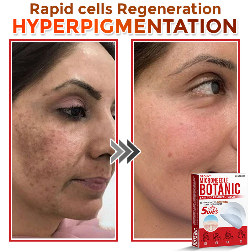 🔥🎇techcrass® MicroNeedle Botanic Skin Tag Removal Patch 🇺🇸 Made in the USA