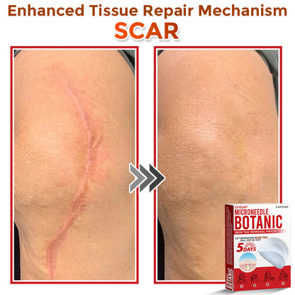 🔥🎇techcrass® MicroNeedle Botanic Skin Tag Removal Patch 🇺🇸 Made in the USA